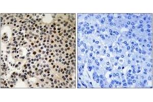 Immunohistochemistry analysis of paraffin-embedded human breast carcinoma, using PAK2 (Phospho-Ser197) Antibody.