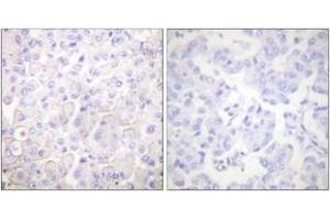 Immunohistochemistry analysis of paraffin-embedded human breast carcinoma tissue, using Cadherin-pan Antibody. (Cadherin 抗体  (AA 833-882))