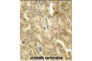 Formalin-fixed and paraffin-embedded human prostata carcinoma tissue reacted with HSP40 Antibody (ABIN1882092 and ABIN2846365) , which was peroxidase-conjugated to the secondary antibody, followed by DAB staining. (DNAJB1 抗体)