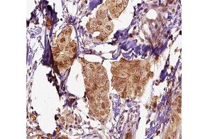 ABIN6266582 at 1/100 staining human breast carcinoma tissue sections by IHC-P. (Mammaglobin A 抗体  (Internal Region))