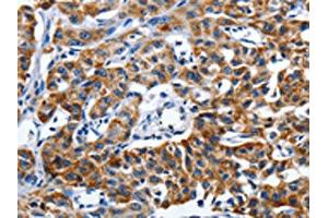 The image on the left is immunohistochemistry of paraffin-embedded Human lung cancer tissue using ABIN7191255(LAMA1 Antibody) at dilution 1/25, on the right is treated with synthetic peptide. (Laminin alpha 1 抗体)