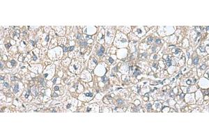 Immunohistochemistry of paraffin-embedded Human liver cancer tissue using RHBDL2 Polyclonal Antibody at dilution of 1:110(x200)