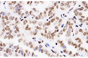 Immunohistochemistry of paraffin-embedded Human thyroid cancer using MonoMethyl-Histone H3-K4 Polyclonal Antibody at dilution of 1:200 (40x lens).