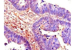 Immunohistochemistry of paraffin-embedded human ovarian cancer using ABIN7158853 at dilution of 1:100 (CDC25B 抗体  (AA 1-195))