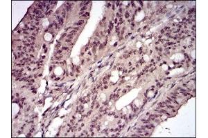 Immunohistochemical analysis of paraffin-embedded human rectum cancer tissues using CCNE1 mouse mAb with DAB staining.