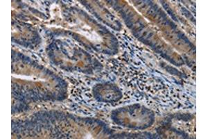 The image on the left is immunohistochemistry of paraffin-embedded Human colon cancer tissue using ABIN7191144(ITPR2 Antibody) at dilution 1/40, on the right is treated with synthetic peptide. (ITPR2 抗体)