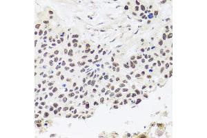 Immunohistochemistry of paraffin-embedded human lung cancer using RPP30 antibody at dilution of 1:100 (x40 lens). (RPP30 抗体)