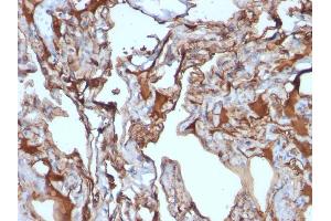 Formalin-fixed, paraffin-embedded human Melanoma stained with MUC18 Mouse Monoclonal Antibody (MUC18/1130). (MCAM 抗体)