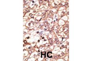 Formalin-fixed and paraffin-embedded human hepatocellular carcinoma tissue reacted with KREMEN1 polyclonal antibody , which was peroxidase-conjugated to the secondary antibody, followed by AEC staining. (KREMEN1 抗体  (N-Term))