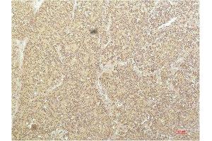 Immunohistochemical analysis of paraffin-embedded Human Kidney Carcinoma Tissue using SGK1 Mouse mAb diluted at 1:200. (SGK1 抗体  (AA 350-430))