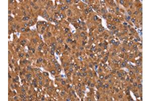 The image on the left is immunohistochemistry of paraffin-embedded Human liver cancer tissue using ABIN7191000(HRASLS2 Antibody) at dilution 1/40, on the right is treated with synthetic peptide. (HRASLS2 抗体)