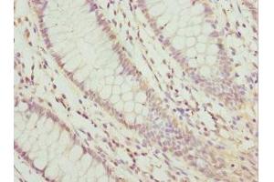Immunohistochemistry of paraffin-embedded human colon cancer using ABIN7157970 at dilution of 1: 100 (LEFTY2 抗体  (AA 57-366))