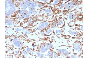 Formalin-fixed, paraffin-embedded human Colon Carcinoma stained with Vimentin Mouse Monoclonal Antibody (VIM/3736). (Vimentin 抗体  (AA 2-466))