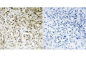 Immunohistochemistry analysis of paraffin-embedded human liver carcinoma tissue using TAF5 antibody. (TAF5 抗体)
