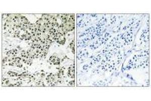 Immunohistochemistry analysis of paraffin-embedded human breast carcinoma tissue using THOC5 antibody. (THO Complex 5 抗体)