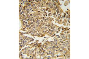 HIF1A Antibody (N-term) (ABIN650972 and ABIN2840017) IHC analysis in formalin fixed and paraffin embedded lung carcinoma followed by peroxidase conjugation of the secondary antibody and DAB staining. (HIF1A 抗体  (N-Term))