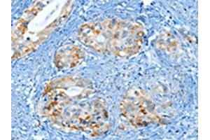 The image on the left is immunohistochemistry of paraffin-embedded Human cervical cancer tissue using ABIN7130299(MUC15 Antibody) at dilution 1/25, on the right is treated with fusion protein. (MUC15 抗体)