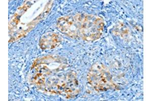 The image on the left is immunohistochemistry of paraffin-embedded Human cervical cancer tissue using ABIN7130299(MUC15 Antibody) at dilution 1/25, on the right is treated with fusion protein. (MUC15 抗体)