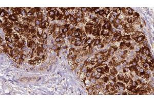 ABIN6272680 at 1/100 staining Human liver cancer tissue by IHC-P. (CCR3 抗体  (C-Term))