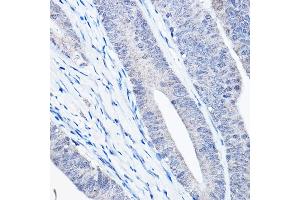 Immunohistochemistry of paraffin-embedded human colon carcinoma using Bax Rabbit mAb  at dilution of 1:25,1:50 (40x lens). (BAX 抗体)