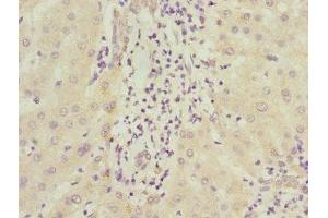 Immunohistochemistry of paraffin-embedded human liver cancer using ABIN7156542 at dilution of 1:100 (ICAM4 抗体  (AA 20-140))