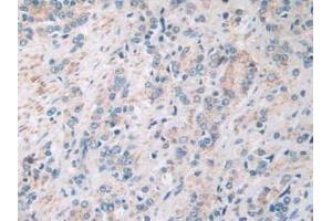IHC-P analysis of Human Prostate Gland Cancer Tissue, with DAB staining. (SIRT4 抗体  (AA 28-314))