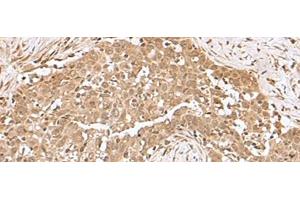 Immunohistochemistry of paraffin-embedded Human esophagus cancer tissue using RCHY1 Polyclonal Antibody at dilution of 1:50(x200) (RCHY1 抗体)
