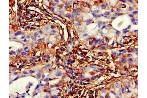 Immunohistochemistry of paraffin-embedded human lung cancer using ABIN7175344 at dilution of 1:100 (VMP1 抗体  (AA 136-235))
