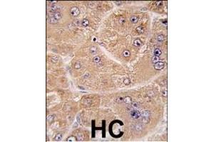 Formalin-fixed and paraffin-embedded human hepatocarcinoma tissue reacted with FUCA2 antibody (N-term) (ABIN391985 and ABIN2841774) , which was peroxidase-conjugated to the secondary antibody, followed by DAB staining. (FUCA2 抗体  (N-Term))