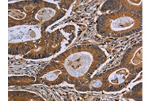 The image on the left is immunohistochemistry of paraffin-embedded Human colon cancer tissue using ABIN7190808(GJB4 Antibody) at dilution 1/40, on the right is treated with synthetic peptide.
