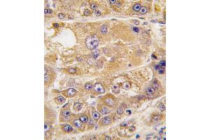 Formalin-fixed and paraffin-embedded human hepatocarcinoma tissue reacted with LDLRAP1 antibody , which was peroxidase-conjugated to the secondary antibody, followed by DAB staining. (LDLRAP1 抗体  (C-Term))