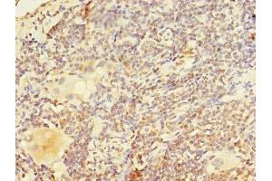 Immunohistochemistry of paraffin-embedded human lung cancer using ABIN7162495 at dilution of 1:100