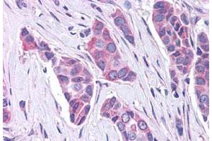 Immunohistochemistry (Formalin/PFA-fixed paraffin-embedded sections) of human breast cancer tissue with GPER polyclonal antibody . (GPER 抗体  (C-Term))
