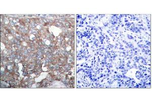 Immunohistochemical analysis of paraffin-embedded human breast carcinoma tissue, using Cortactin (Ab-421) antibody (E021263). (Cortactin 抗体)
