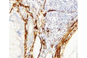 IHC-P: Caveolin-1 antibody testing of human breast cancer tissue (Caveolin-1 抗体  (C-Term))
