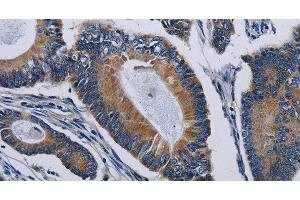 Immunohistochemistry of paraffin-embedded Human colon cancer tissue using PCDHAC2 Polyclonal Antibody at dilution 1:50 (PCDHAC2 抗体)