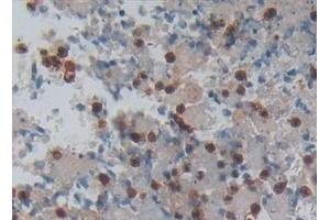 Detection of PP13 in Human Lung cancer Tissue using Polyclonal Antibody to Placental Protein 13 (PP13) (LGALS13 抗体  (AA 1-139))