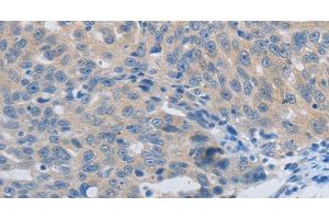 Immunohistochemistry of paraffin-embedded Human ovarian cancer using MMP8 Polyclonal Antibody at dilution of 1:45 (MMP8 抗体)