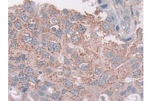 Detection of CXADR in Human Breast cancer Tissue using Polyclonal Antibody to Coxsackie Virus And Adenovirus Receptor (CXADR) (Coxsackie Adenovirus Receptor 抗体  (AA 20-229))