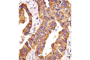 Antibody staining MMP14 in human lung adenocarcinoma tissue sections by Immunohistochemistry (IHC-P - paraformaldehyde-fixed, paraffin-embedded sections). (MMP14 抗体  (N-Term))