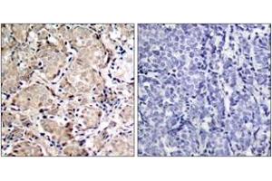 Immunohistochemistry analysis of paraffin-embedded human breast carcinoma, using FKHR (Phospho-Ser319) Antibody. (FOXO1 抗体  (pSer319))