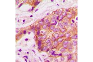 Immunohistochemical analysis of Alpha-adducin (pT445) staining in human breast cancer formalin fixed paraffin embedded tissue section.