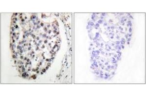 Immunohistochemistry analysis of paraffin-embedded human breast carcinoma tissue, using MYF5 (Ab-49) Antibody. (MYF5 抗体  (AA 21-70))