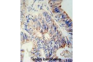 B3GNT6 Antibody (Center) immunohistochemistry analysis in formalin fixed and paraffin embedded human colon carcinoma followed by peroxidase conjugation of the secondary antibody and DAB staining.