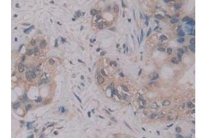 Detection of MPG1 in Human Liver cancer Tissue using Polyclonal Antibody to Macrophage Expressed Gene 1 Protein (MPG1) (MPEG1 抗体  (AA 313-580))