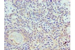 Immunohistochemistry of paraffin-embedded human breast cancer using ABIN7150350 at dilution of 1:100 (TOPBP1 抗体  (AA 1253-1522))