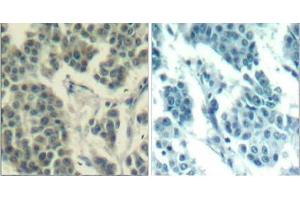 Immunohistochemical analysis of paraffin- embedded human breast carcinoma tissue using Her3/ErbB3 (phospho-Tyr1328) Antibody (E011510) . (ERBB3 抗体  (pTyr1328))
