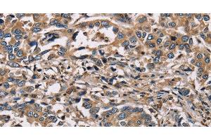 Immunohistochemistry of paraffin-embedded Human liver cancer using HSD17B12 Polyclonal Antibody at dilution of 1:30 (HSD17B12 抗体)