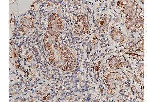 ABIN6269175 at 1/200 staining human breast cancer tissue sections by IHC-P. (FLT1 抗体)