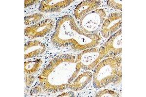 Immunohistochemical analysis of SGK1 staining in human colon cancer formalin fixed paraffin embedded tissue section. (SGK1 抗体  (C-Term))